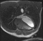 Active right ventricular cardiac sarcoidosis (Radiopaedia 55596-62100 Axial Dynamic perfusion scan MOCO 71).jpg