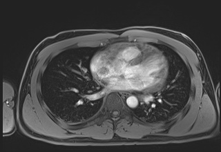 Active right ventricular cardiac sarcoidosis (Radiopaedia 55596-62100 Axial Post contrast Dixon 43).jpg