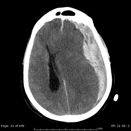File:Acute-on-chronic subdural hematoma (Radiopaedia 4833).jpg