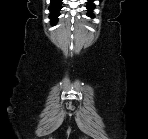Acute appendicitis, heterotaxy syndrome (Radiopaedia 66884-76202 Coronal C+ portal venous phase 113).jpg