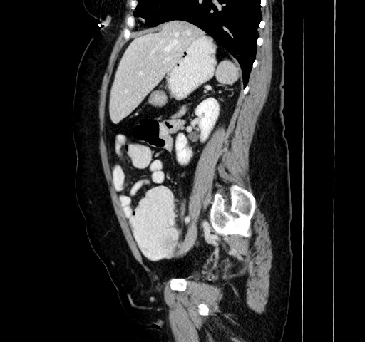 Acute appendicitis, heterotaxy syndrome (Radiopaedia 66884-76202 Sagittal C+ portal venous phase 54).jpg