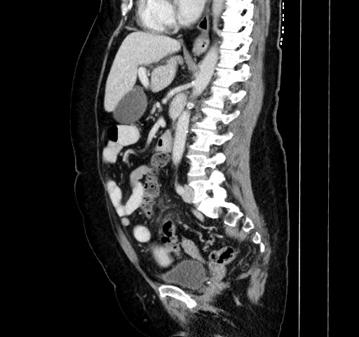 Acute appendicitis, heterotaxy syndrome (Radiopaedia 66884-76202 Sagittal C+ portal venous phase 75).jpg