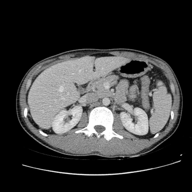 Acute appendicitis (Radiopaedia 27049-27227 Axial C+ portal venous phase 24).jpg