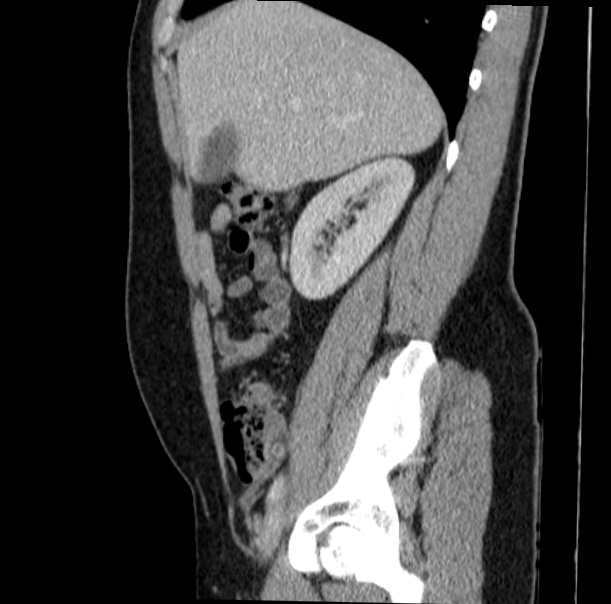 Acute appendicitis (Radiopaedia 38255-40270 Sagittal C+ portal venous phase 26).jpg