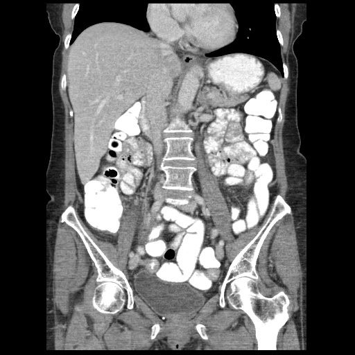 Acute appendicitis (Radiopaedia 52672-58589 Coronal C+ portal venous phase 56).jpg