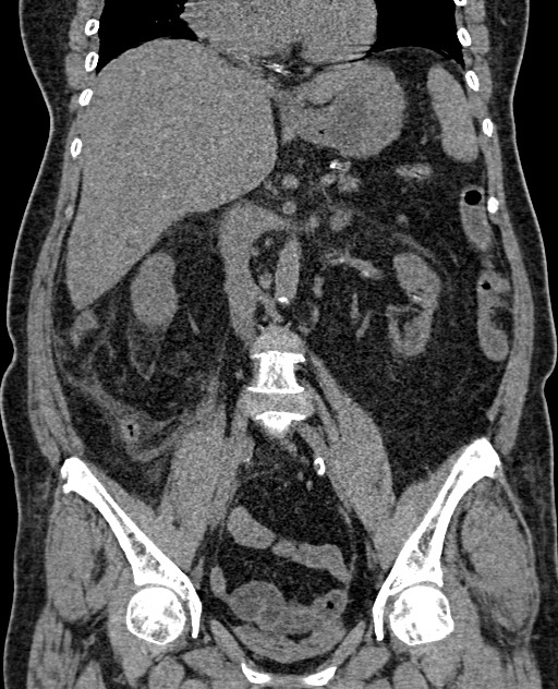 Acute appendicitis (Radiopaedia 58627-65818 Coronal non-contrast 41).jpg