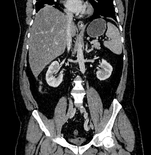 Acute appendicitis (Radiopaedia 79950-93224 Coronal C+ portal venous phase 52).jpg