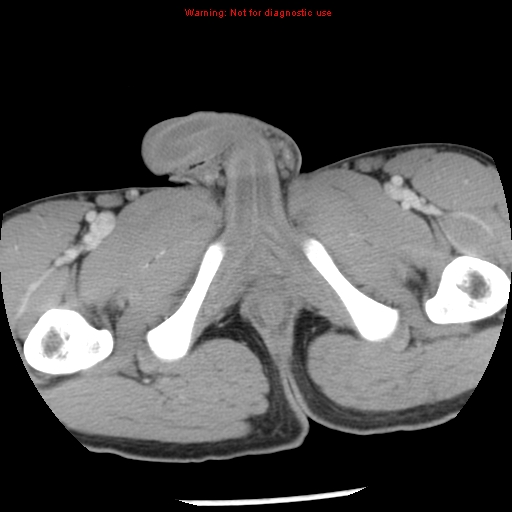 Acute appendicitis (Radiopaedia 8195-9045 Axial C+ portal venous phase 83).jpg