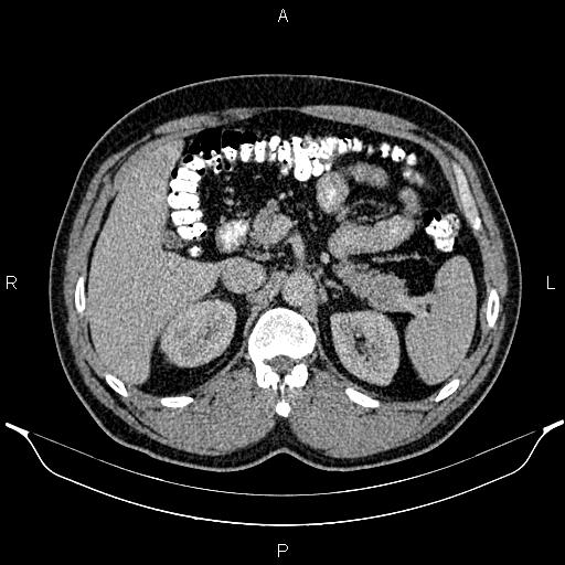 File:Acute appendicitis (Radiopaedia 84780-100240 Axial C+ portal venous phase 34).jpg