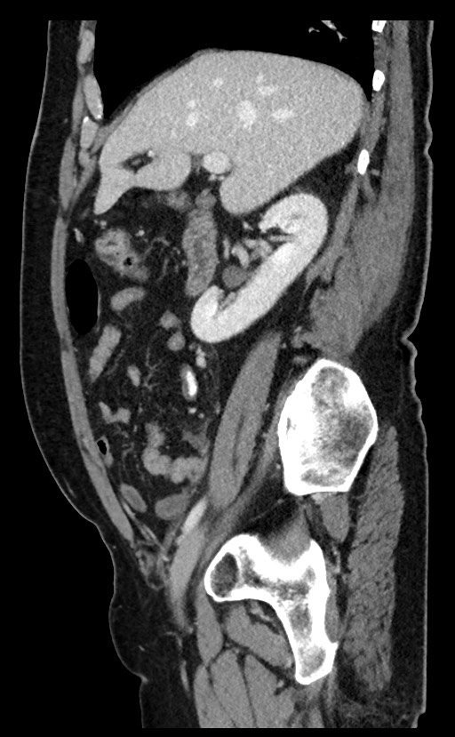 Acute appendicitis - large appendicoliths (Radiopaedia 61805-69820 Sagittal C+ portal venous phase 77).jpg