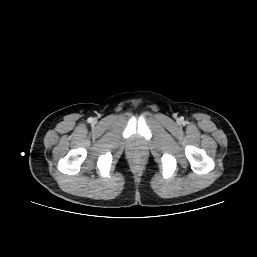 Acute appendicitis and COVID 19 pneumonia (Radiopaedia 76604-88380 Axial C+ portal venous phase 88).jpg