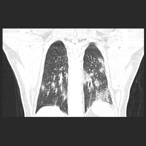 Acute appendicitis and COVID 19 pneumonia (Radiopaedia 76604-88380 G 48).jpg