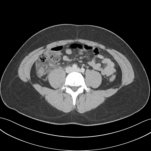 Acute appendicitis with appendicoliths (Radiopaedia 50186-55532 Axial C+ portal venous phase 49).png