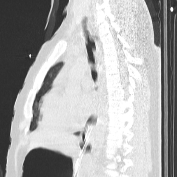 Acute aspiration pneumonitis (Radiopaedia 33605-34703 Sagittal lung window 47).jpg