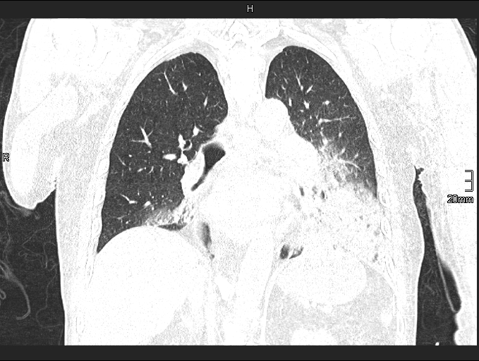 Acute aspiration pneumonitis (Radiopaedia 55642-62166 Coronal lung window 62).jpg