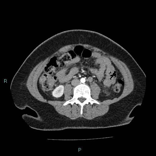 Acute bilateral pyelonephritis (Radiopaedia 37146-38881 Axial C+ arterial phase 108).jpg
