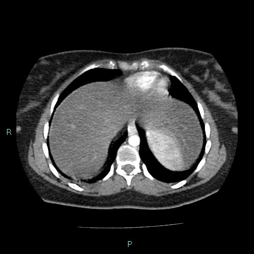 Acute bilateral pyelonephritis (Radiopaedia 37146-38881 Axial C+ arterial phase 13).jpg