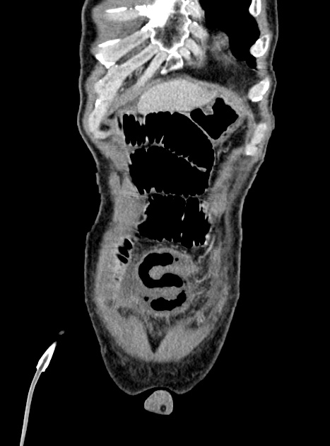 Acute bowel ischemia (Radiopaedia 87695-104114 Coronal C+ portal venous phase 87).jpg