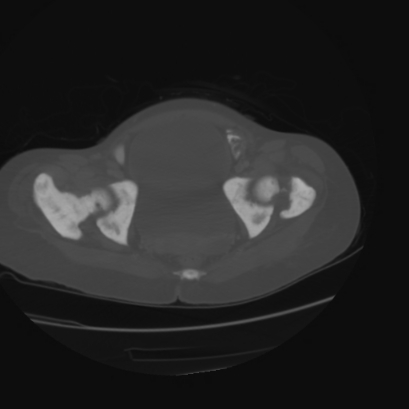 Acute calculous cholecystitis in patient with osteopetrosis (Radiopaedia 77871-90159 Axial bone window 47).jpg
