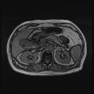 Acute cholecystitis (Radiopaedia 72392-82923 Axial T1 out-of-phase 53).jpg