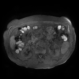 Acute cholecystitis complicated by pylephlebitis (Radiopaedia 65782-74915 Axial T1 fat sat 75).jpg