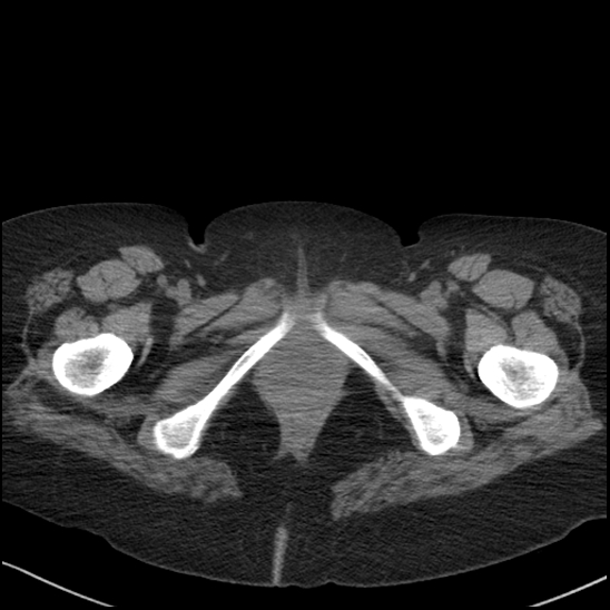 Acute colonic hemorrhage in ulcerative colitis (Radiopaedia 77415-89538 Axial non-contrast 144).jpg