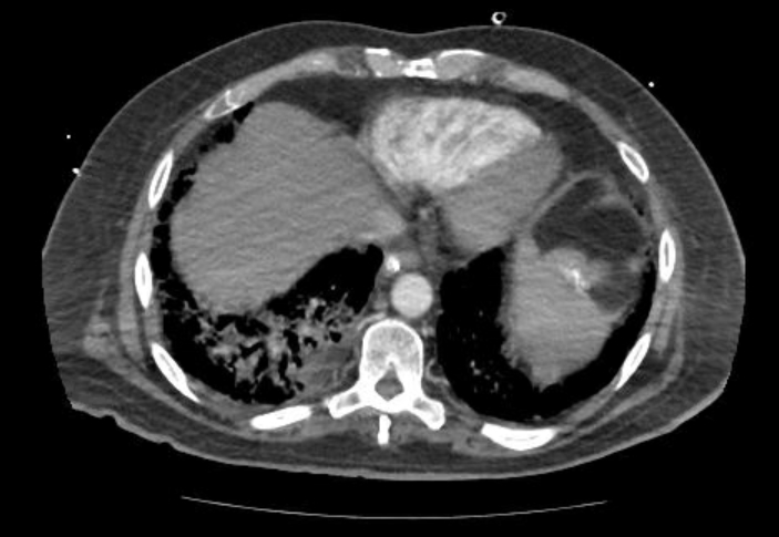 Acute cor pulmonale (ultrasound) (Radiopaedia 83508-98818 Axial C+ CTPA 61).jpg
