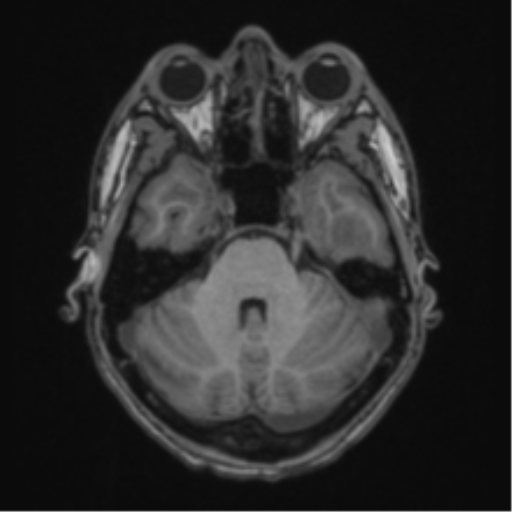 Acute disseminated encephalomyelitis (ADEM) (Radiopaedia 65319-74349 Axial T1 15).png