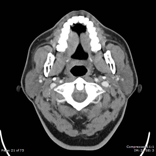 Acute epiglottitis (Radiopaedia 54375-60590 Axial C+ arterial phase 21).jpg