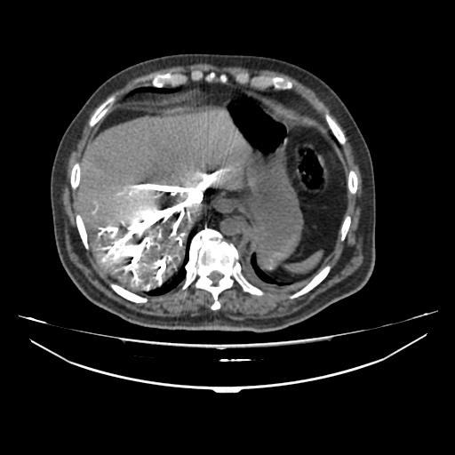 Acute heart failure (CT) (Radiopaedia 79835-93075 Axial C+ arterial phase 67).jpg