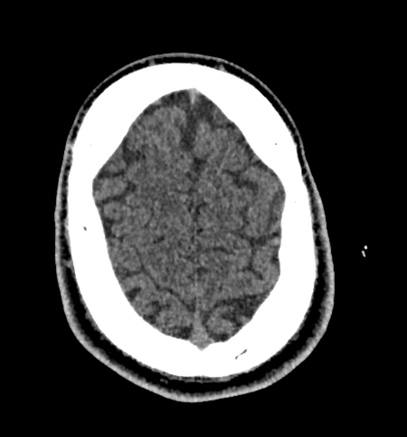 Acute ischemic stroke - posterior circulation territory (Radiopaedia 77670-89881 non-contrast 79).jpg