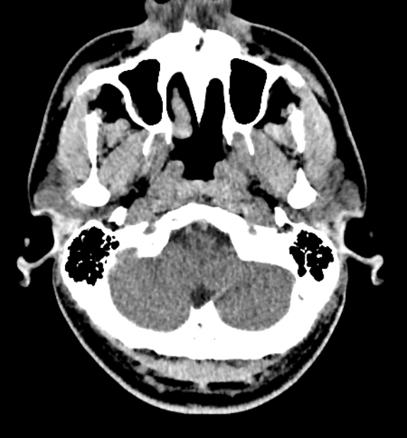 Acute ischemic stroke - posterior circulation territory (Radiopaedia 77670-89881 non-contrast 8).jpg
