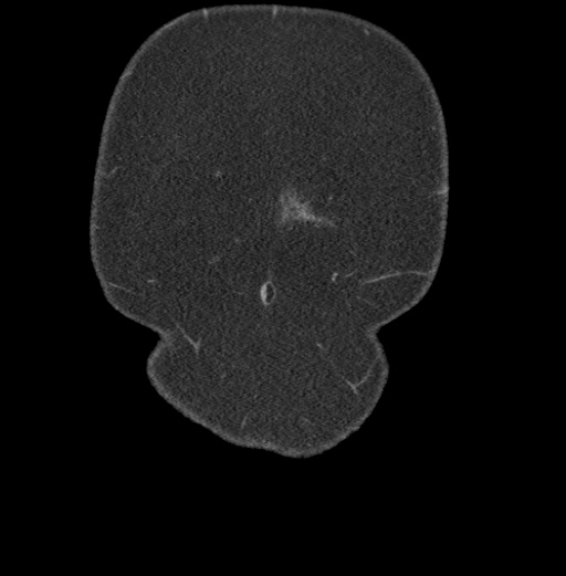 Acute mesenteric venous ischemia (Radiopaedia 46041-50383 Coronal C+ portal venous phase 1).jpg