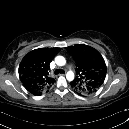 File:Acute myocardial infarction in CT (Radiopaedia 39947-42415 Axial C+ arterial phase 46).jpg