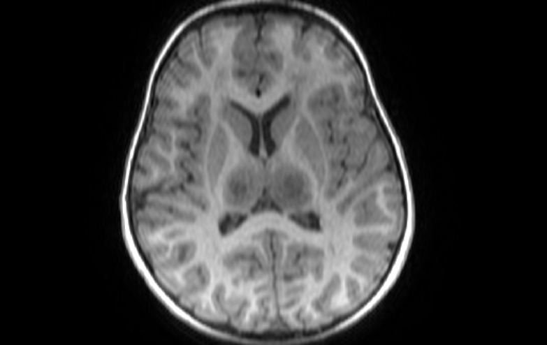 Acute necrotizing encephalitis of childhood (Radiopaedia 67356-76737 Axial T1 42).jpg