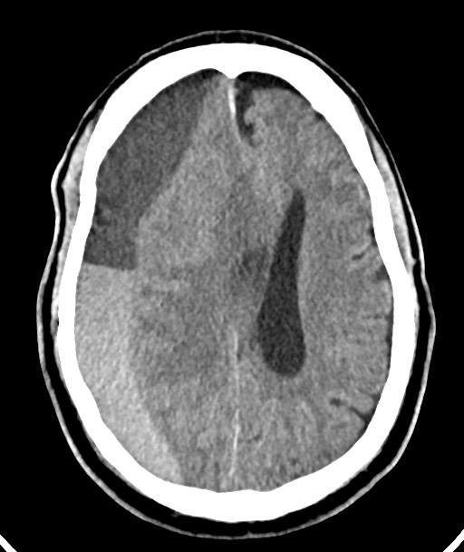 Acute on chronic subdural hematoma (Radiopaedia 78346-90966 Axial non-contrast 38).jpg
