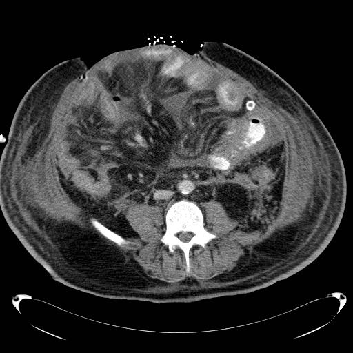 Acute pancreatic necrosis (Radiopaedia 13560-18503 Axial C+ portal venous phase 48).jpg