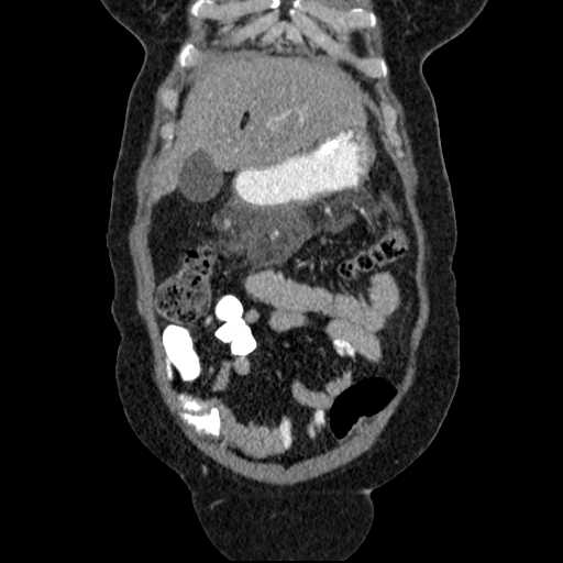 File:Acute pancreatitis (Radiopaedia 20829-20744 Coronal C+ portal venous phase 13).jpg