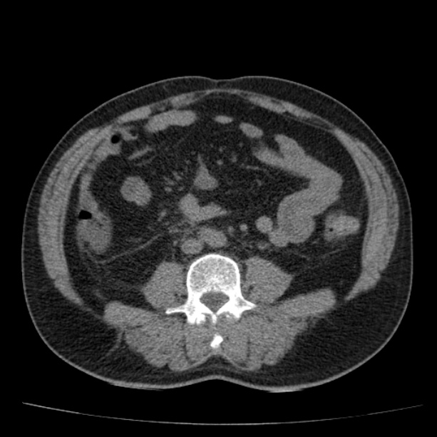 Acute pancreatitis (Radiopaedia 26663-26813 Axial non-contrast 61).jpg