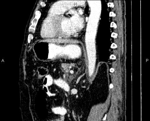 Acute pancreatitis (Radiopaedia 85146-100701 Sagittal C+ portal venous phase 58).jpg