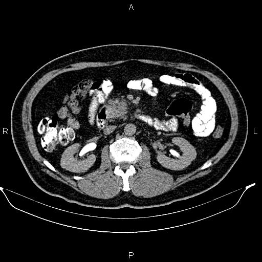 Acute pancreatitis (Radiopaedia 85390-101010 Axial C+ delayed 36).jpg