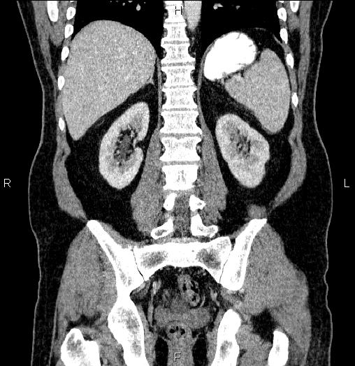 Acute pancreatitis (Radiopaedia 85390-101010 Coronal C+ portal venous phase 51).jpg