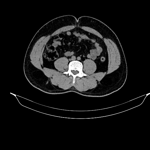 File:Acute pancreatitis (Radiopaedia 87428-103757 Axial non-contrast 62).jpg
