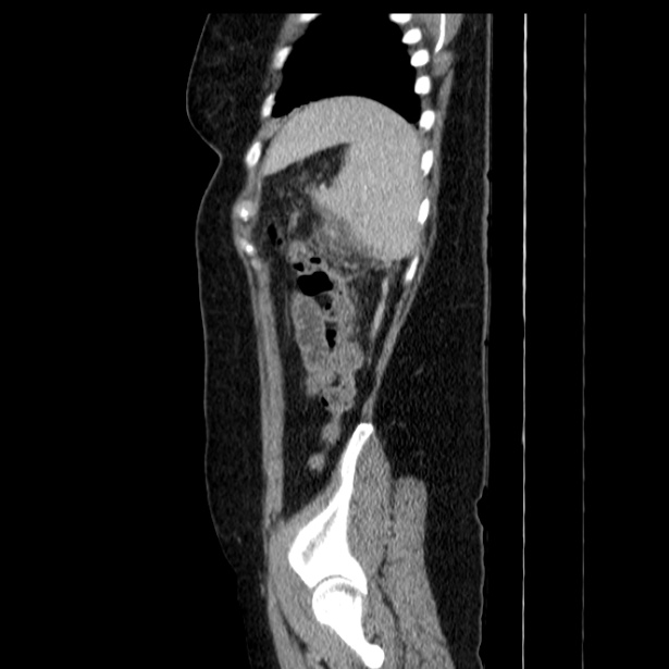 Acute pancreatitis - Balthazar C (Radiopaedia 26569-26714 Sagittal C+ portal venous phase 56).jpg