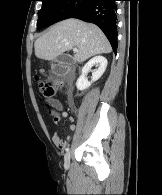 Acute pancreatitis - Balthazar E (Radiopaedia 23080-23110 Sagittal C+ portal venous phase 27).jpg