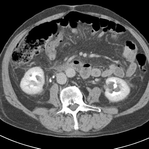 Acute pancreatitis and walled-off necrosis (Radiopaedia 29888-30403 Axial C+ delayed 44).jpg