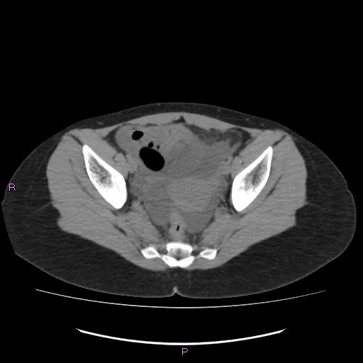 Acute pancreatitis secondary to stone at minor papilla and pancreatic divisum (Radiopaedia 76570-88333 Axial non-contrast 66).jpg