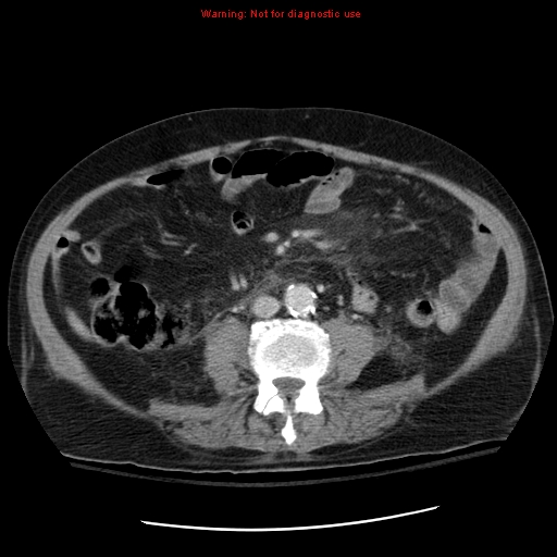 File:Acute pancreatitis with incidental pancreatic lipoma (Radiopaedia 10190-10730 Axial C+ portal venous phase 44).jpg