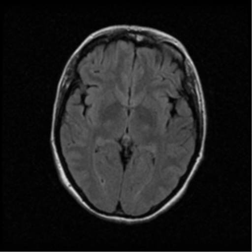 File:Acute pontine infarct from vertebral artery dissection (Radiopaedia 34111-35370 Axial FLAIR 10).png
