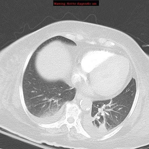 File:Acute pulmonary embolism (Radiopaedia 13286-13289 B 29).jpg
